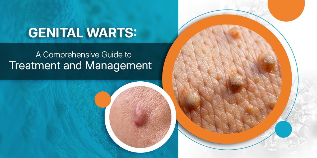 Genital Warts: A Comprehensive Guide to Treatment and Management